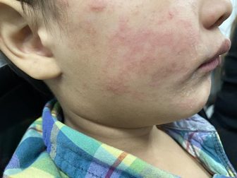 Kosciusko County reports its first measles case as Indiana's total reaches 74