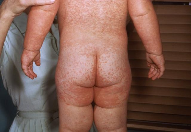 Measles cases keep climbing in Northeast Indiana as the state total reaches 34